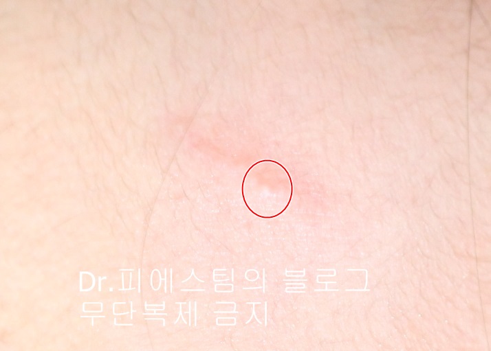 응급실에서 얼굴 상처 일반 봉합 후, 성형외과 흉터 레이저 치료 사례 - 뺨 & 이마 (2) 입니다 관련 이미지 9