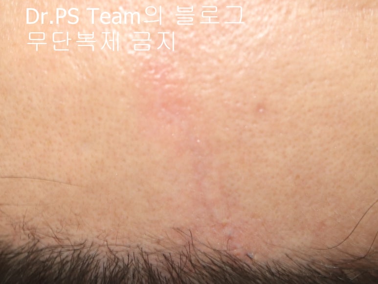 얼굴 찢어진 상처 봉합 & 얼굴 흉터 레이저 성형외과 치료 사례 - 이마 상처 (2) 편입니다. 관련 이미지 7