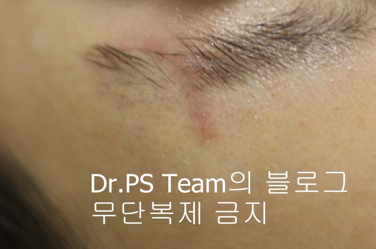 얼굴 찢어진 상처 봉합 성형외과 치료 사례 - 눈썹과 이마 편입니다. 관련 이미지 3