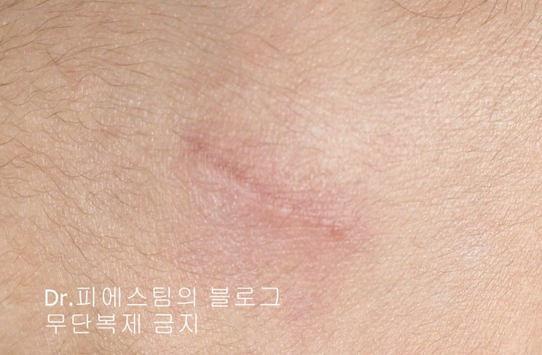 응급실에서 얼굴 상처 일반 봉합 후, 성형외과 흉터 레이저 치료 사례 - 뺨 & 이마 (2) 입니다 관련 이미지 8