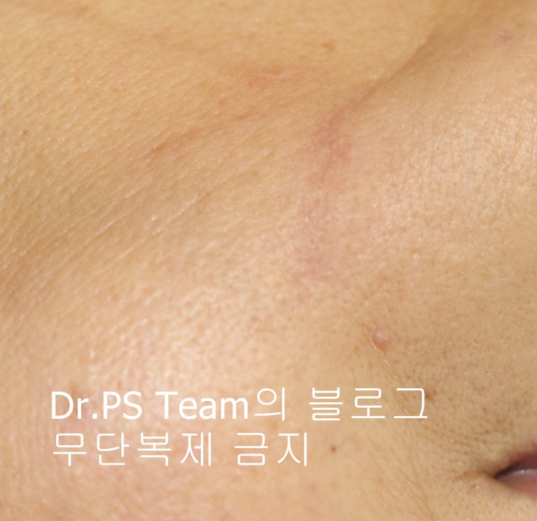 얼굴 찢어진 상처 봉합 & 얼굴 흉터 레이저 성형외과 치료 사례 - 턱 : 긴 상처 편입니다. 관련 이미지 5