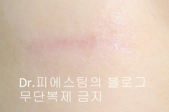 응급실에서 얼굴 상처 일반 봉합 후, 성형외과 레이저 치료 사례 - 뺨 & 이마 (1) 입니다 관련 이미지 5