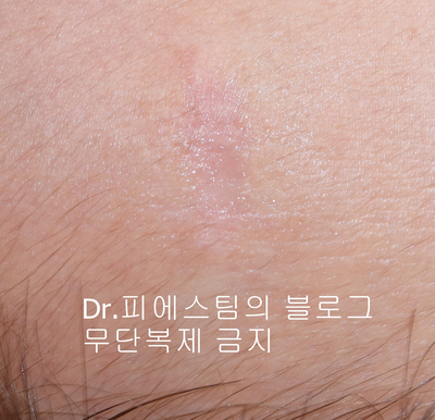 응급실에서 얼굴 상처 일반 봉합 후, 성형외과 흉터 레이저 치료 사례 - 뺨 & 이마 (2) 입니다 관련 이미지 5