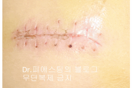 응급실에서 얼굴 상처 일반 봉합 후, 성형외과 레이저 치료 사례 - 뺨 & 이마 (1) 입니다 관련 이미지 9
