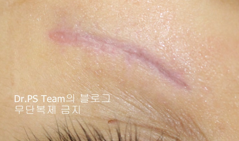 응급실에서 얼굴 상처 일반 봉합 후, 성형외과 흉터 레이저 치료 사례 - 하안검(아래눈꺼풀) 편 입니다 관련 이미지 2