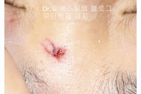 얼굴 찢어진 상처 봉합 성형외과 치료 사례 - 코와 피판에 관하여-1편입니다 관련 이미지 10