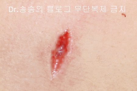 얼굴 상처 봉합 성형외과 치료 사례 - 뺨 1편 관련 이미지 13