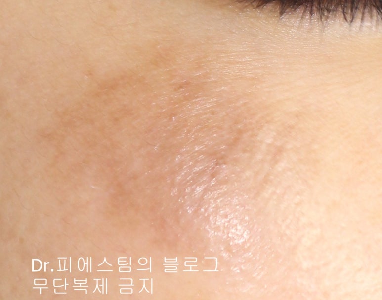 얼굴 상처 봉합 외 표재성 손상, 찰과상의 성형외과 색소침착 치료 사례 - 광대 편입니다 관련 이미지 10