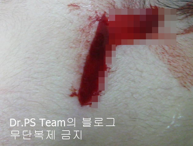 얼굴 찢어진 상처 봉합 & 얼굴 흉터 레이저 성형외과 치료 사례 - 이마 상처 (1) 편입니다. 관련 이미지 3