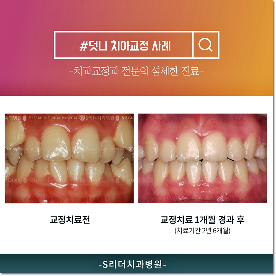 건대교정 치과, 과잉진료없는 투명한 건대치과 관련 이미지 4