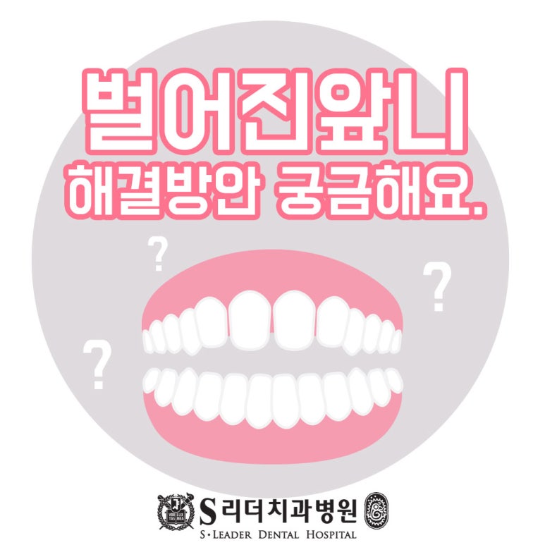 건대교정치과 벌어진앞니 고민 있다면 관련 이미지 1
