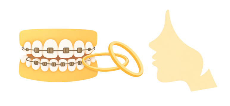 Gwangjin-gu Dental Clinic Recommendation: How Important Is the Elastic Stage in Orthodontic Treatment for Improving Protruding Mouths? image 5