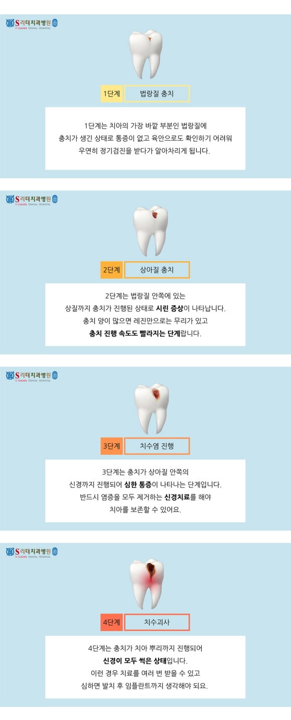 광진구치과 추천 충치치료 레진, 인레이, 크라운 어떤진료 해야할까 관련 이미지 3