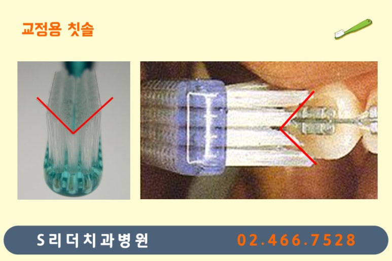 광진구교정치과 치아교정 잘 되기 위한 또하나의 방법? 관련 이미지 5