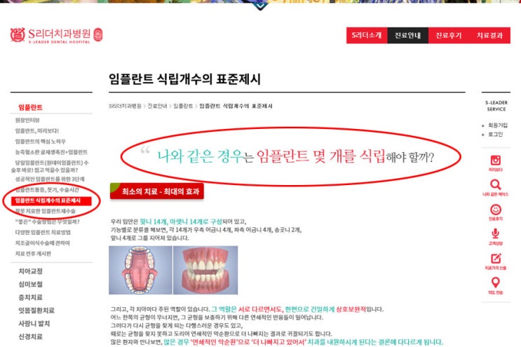 앞니임플란트 몇개를심어요? 관련 이미지 2