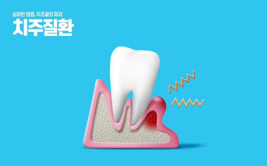 3 Important Things to Note About Chronic and Acute Periodontitis image 10