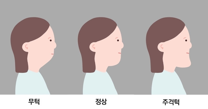 용마산역치과, 덧니 주걱턱 치아교정 개선하기 위한 과정은 관련 이미지 6