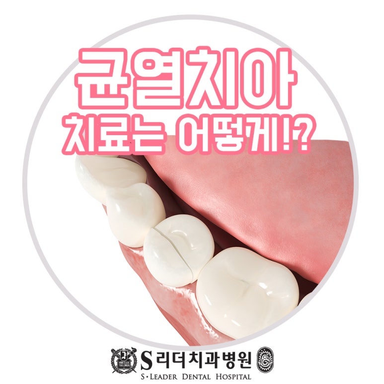 성동구치과 씹을때 찌릿한 통증으로 식사가 어렵다면 관련 이미지 1