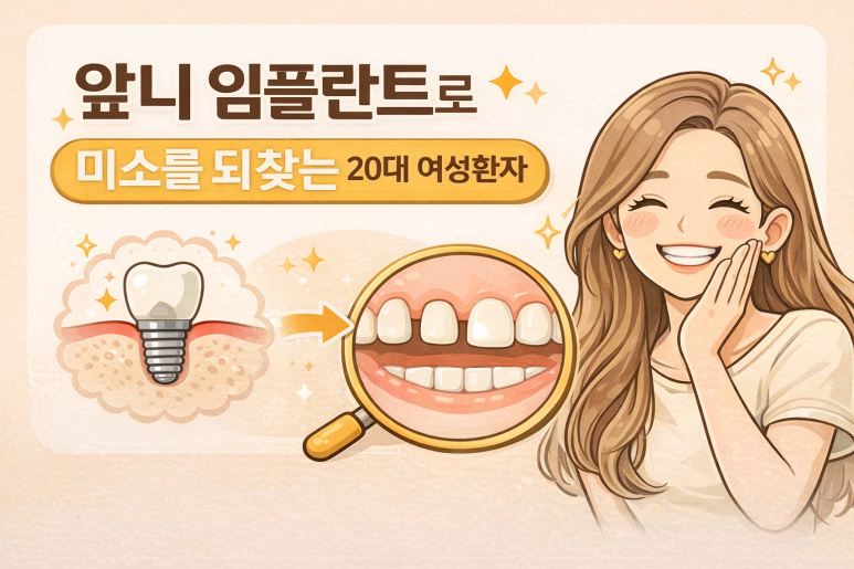 서울임플란트치과에서 말하는 20대 앞니 임플란트, 티 안 나게 가능한 이유 관련 이미지 4