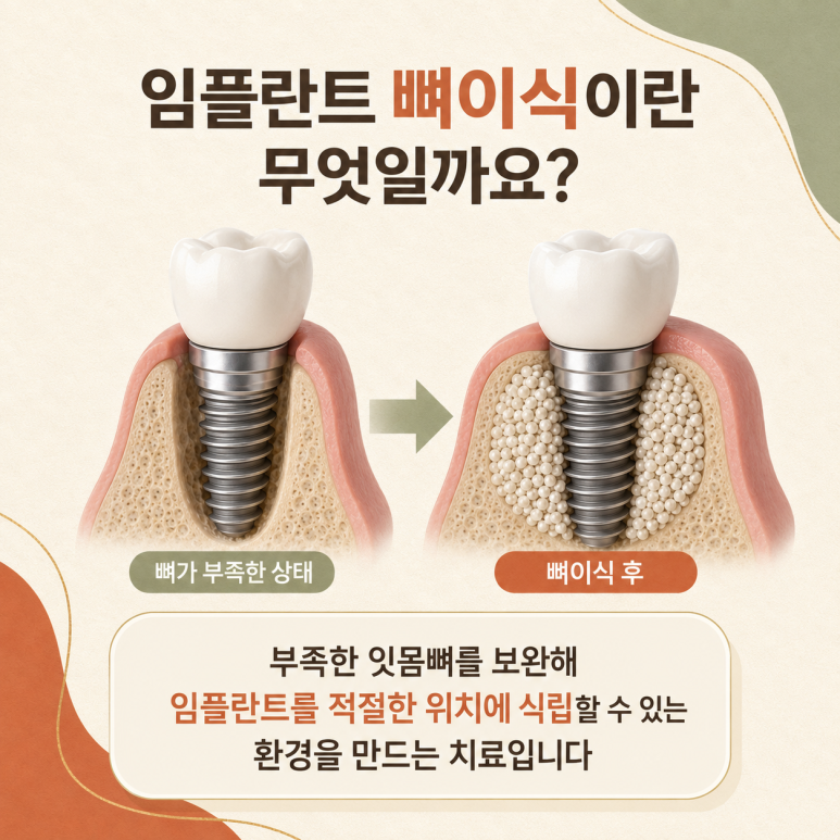 구의동임플란트 뼈이식은 어떤 경우에 필요할까요? 관련 이미지 2
