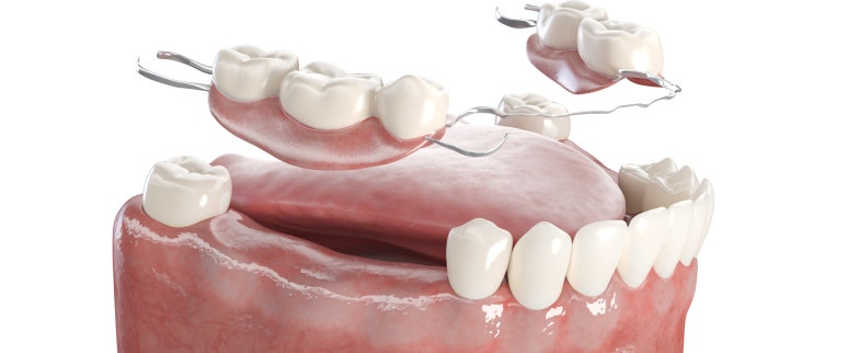 Seongsu-dong Dental Clinic: Why Is an Orthodontic Retainer Important? image 5