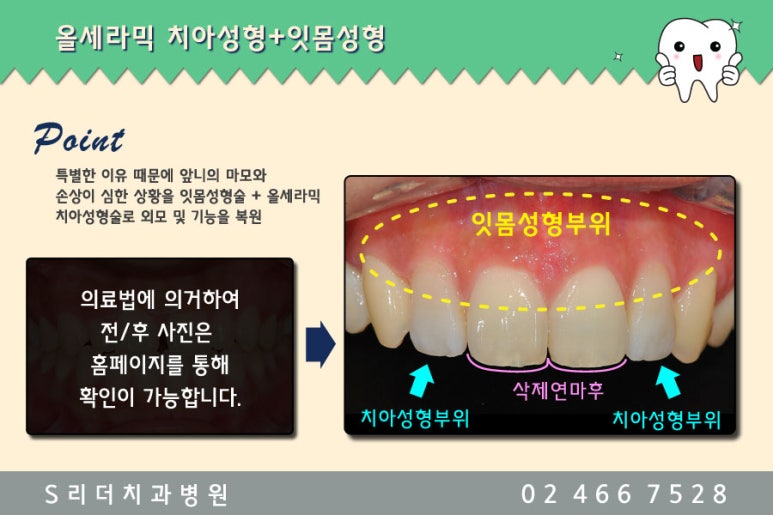 광진구치과 치아성형으로 컴플렉스 극뽁~ 관련 이미지 4