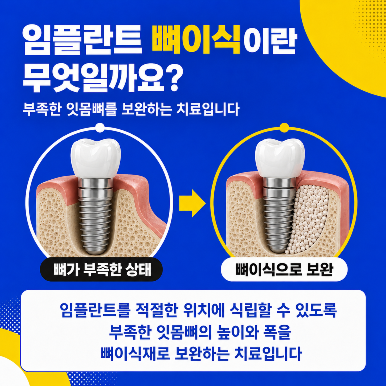 Hwanyang-dong Dental Clinic: Can Bone Grafting and Implant Placement Be Performed at the Same Time? image 2