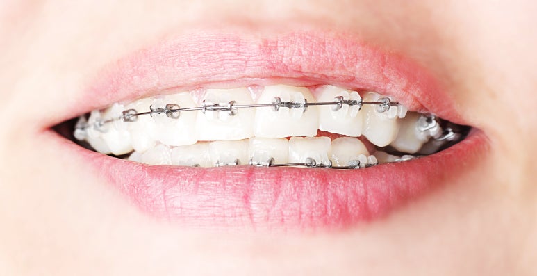 [Neungdong Dental Clinic] Orthodontics: Do You Have to Extract Teeth? Criteria for Deciding Whether Extraction Is Necessary image 3