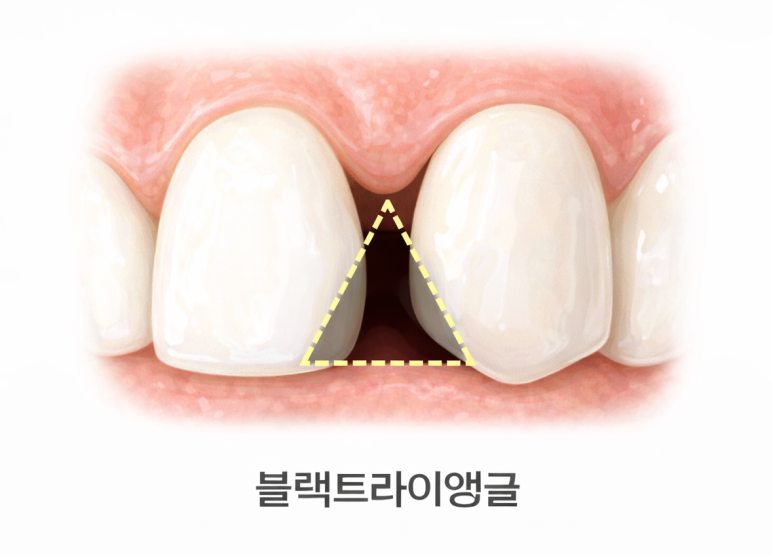 Seoul Yangsim Dental Clinic｜Why Black Triangles Form and How to Fix Them image 2