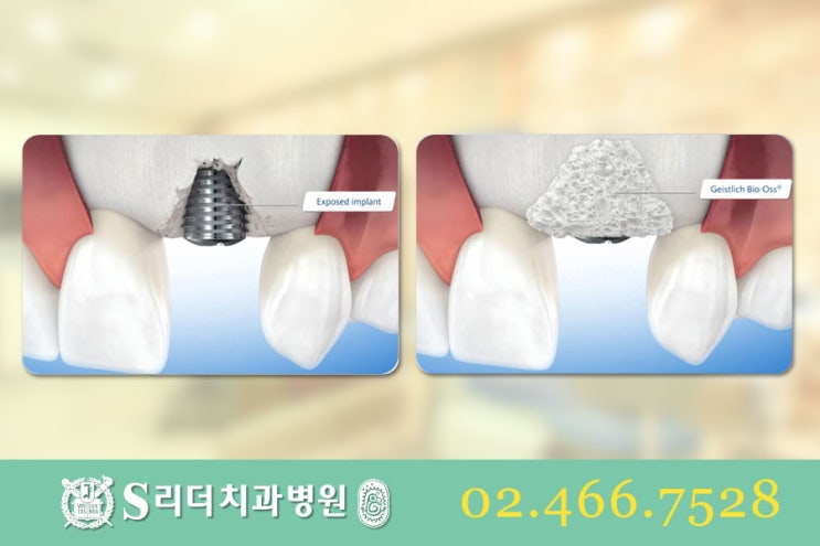 건대당일임플란트 잘하기위한 필수요소 관련 이미지 4