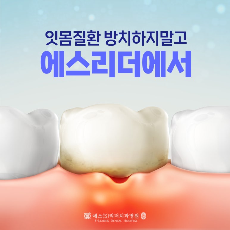 Songjeong-dong Dental Clinic, “Bleeding Gums & Bad Breath… Warning Signs from Tartar” image 4