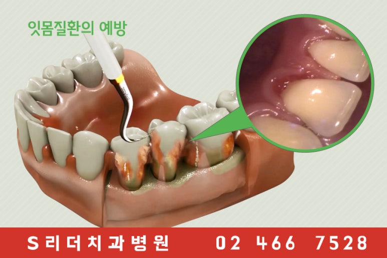 건대치과 잇몸질환 예방할 수 있어요~!! 관련 이미지 4