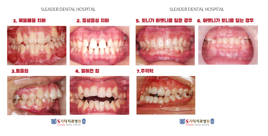 서울치아교정잘하는곳, 신중한 결정과 선택으로 관련 이미지 5