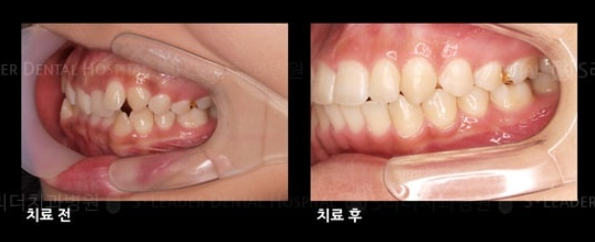 동대문구치과 치아교정, 반대교합&middot;주걱턱 교정 어떻게 할까? 관련 이미지 3