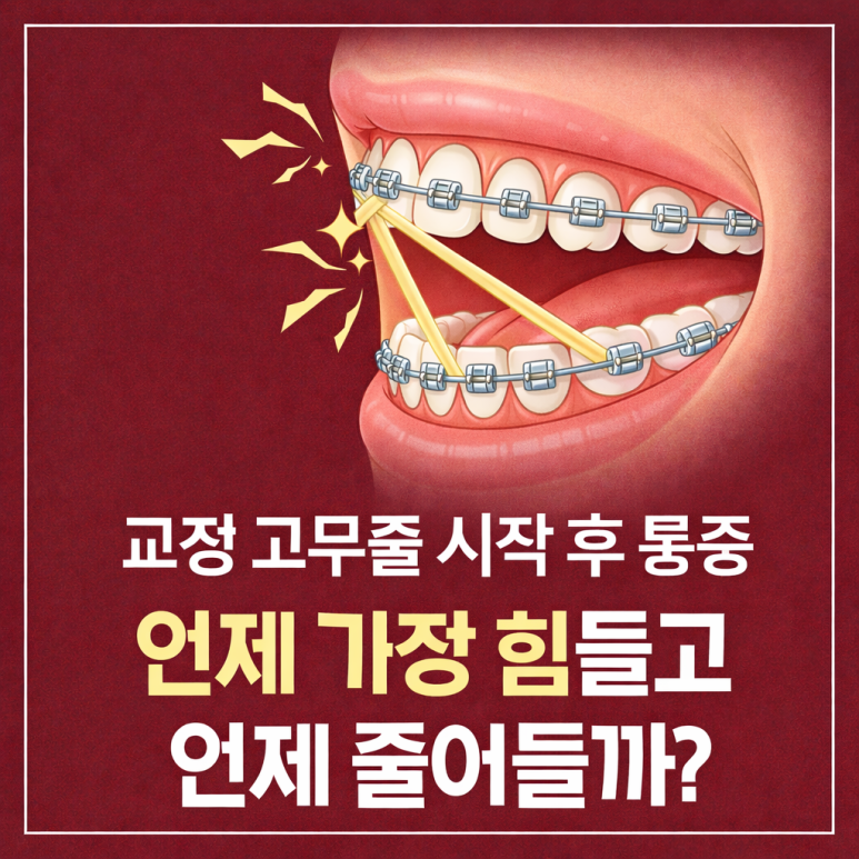 용마산역치과 교정치료｜고무줄 시작 후 통증, 언제 가장 힘들고 언제 줄어들까? 관련 이미지 1