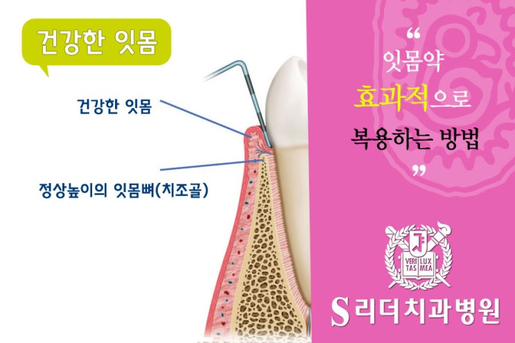 광진구치과 잇몸약을 효과적으로 복용하는 방법 관련 이미지 3