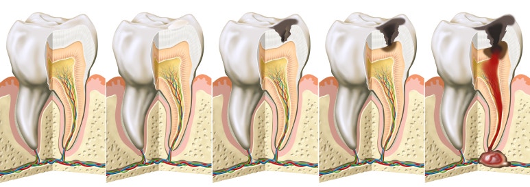 Sagajeong Station Dental Clinic Tooth Throbbing Causes: Do You Need Root Canal Treatment? image 3