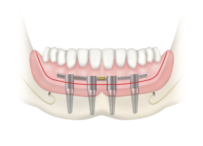 Guwi-dong Dental Clinic 2030 Front Tooth Implants: A Complete Summary of the Must-Know Checkpoints image 5