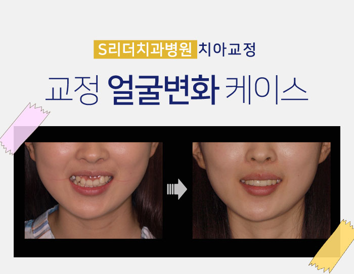 건대입구교정치과 교정얼굴변화 확인해보자 관련 이미지 5
