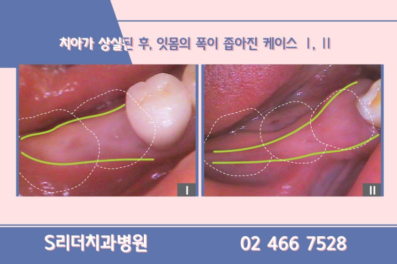 광진구치과 임플란트 단점정리 관련 이미지 7