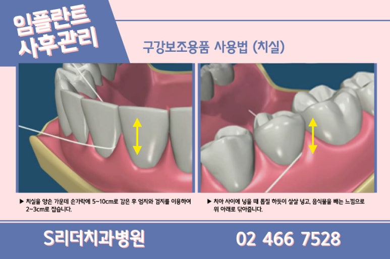 광진구치과 임플란트 단점정리 관련 이미지 18