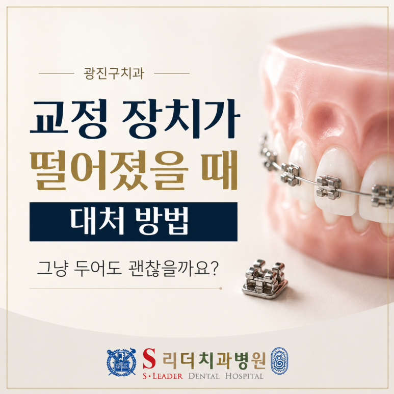 광진구치과|교정 장치가 떨어졌을 때 대처 방법, 그냥 두어도 괜찮을까요? 관련 이미지 1