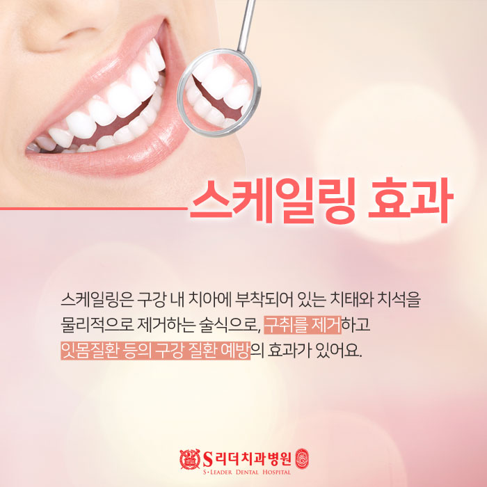 건대스케일링 보험부터 효과까지 알아보기 관련 이미지 2