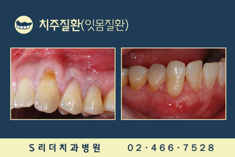 앞니임플란트 2개로 6개치아 완성 관련 이미지 7