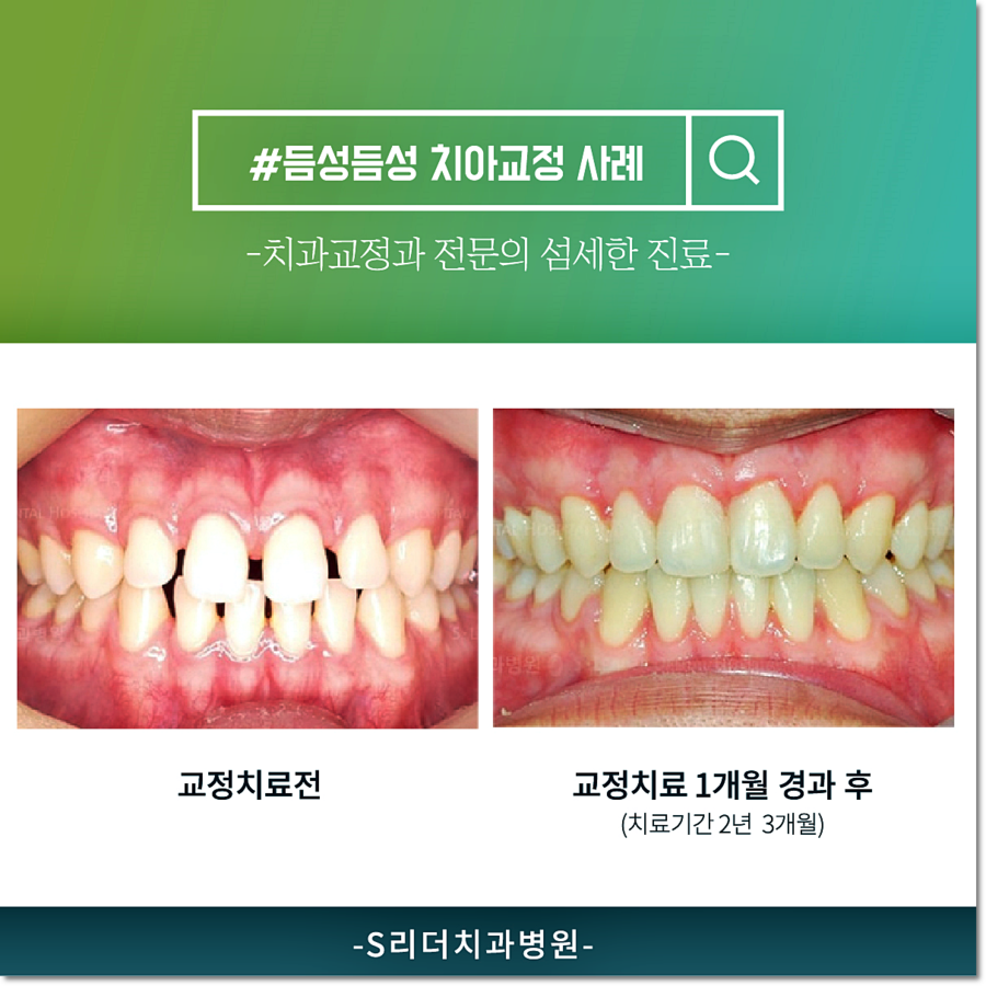 건대교정 치과, 과잉진료없는 투명한 건대치과 관련 이미지 5