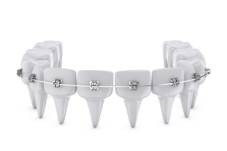 [Songjeong-dong Dental Clinic] When Is Orthodontic Treatment Needed? From Causes to Treatment Timing image 5