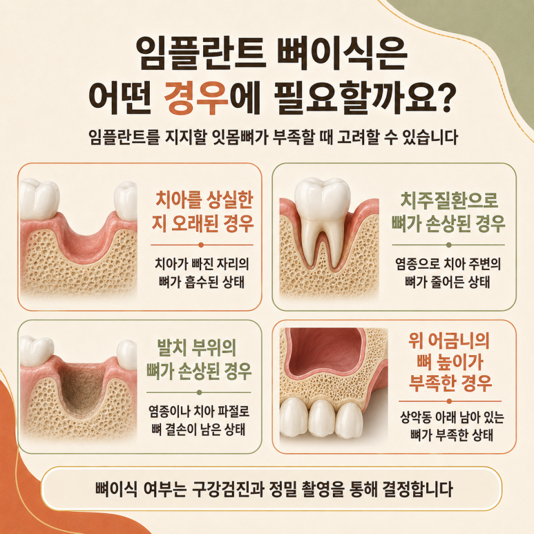구의동임플란트 뼈이식은 어떤 경우에 필요할까요? 관련 이미지 3