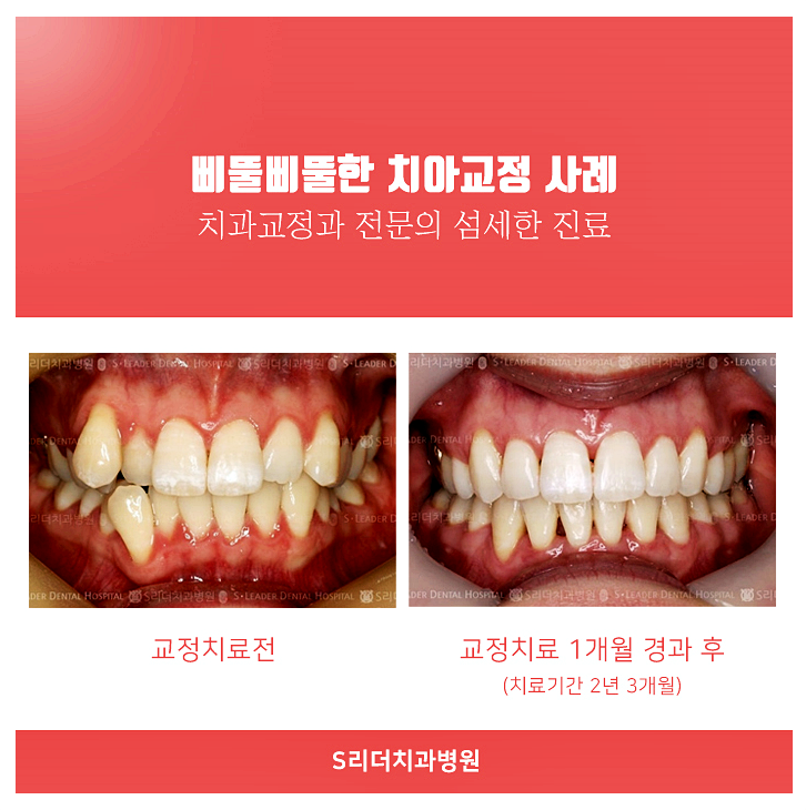 구의동교정치과, 아이들 치아교정에서 가장 중요한 것은? 관련 이미지 6