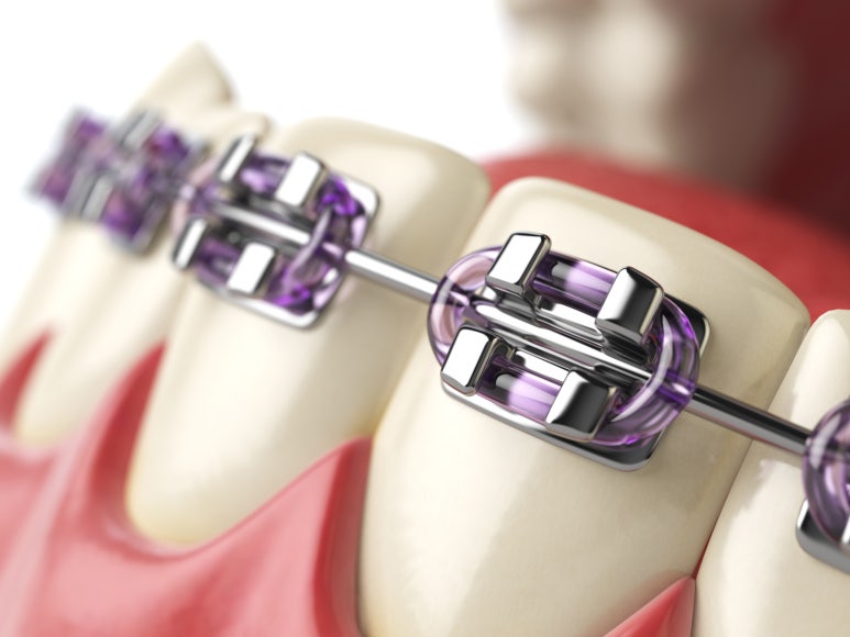 Junggok-dong Dental Clinic: Is the Pain Felt During Orthodontic Treatment Within the Normal Range? image 4