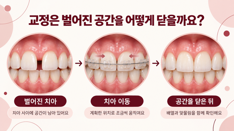 건대역치아교정, 치아 사이가 벌어졌다면 교정으로 해결할 수 있을까요? 관련 이미지 3